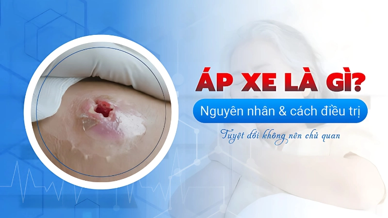 Bị áp xe là gì tình trạng viêm nhiễm gây tụ mủ dưới da