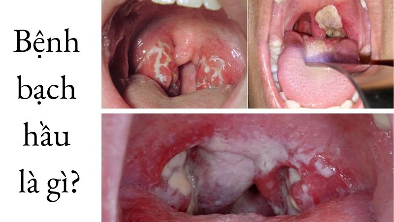 Bệnh bạch hầu là gì và tại sao lại nguy hiểm nếu không điều trị kịp thời