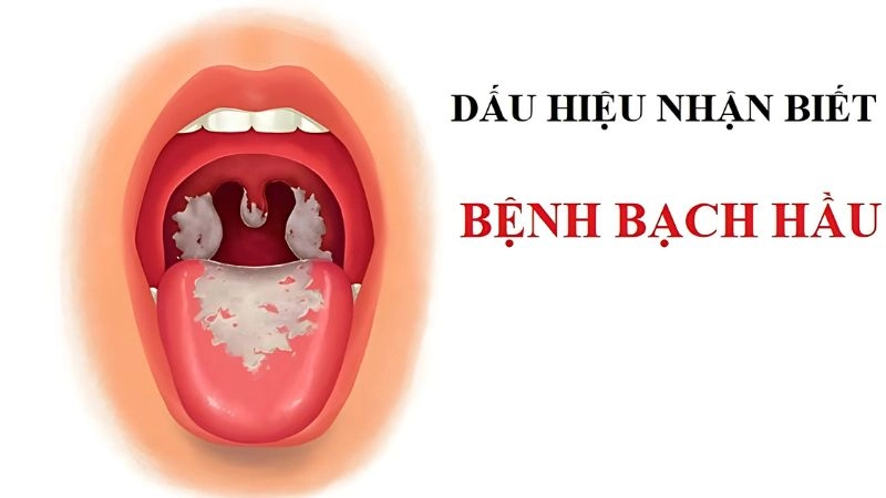 Triệu chứng bệnh bạch hầu ở người lớn dễ bị nhầm với cảm cúm thông thường