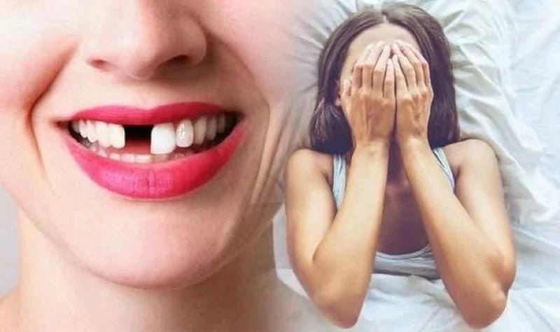 Khám phá giải mã chi tiết nằm mơ gãy răng cửa là điềm gì sâu sắc