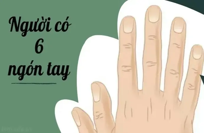 Người có 6 ngón tay tốt hay xấu ảnh hưởng vận mệnh gì?