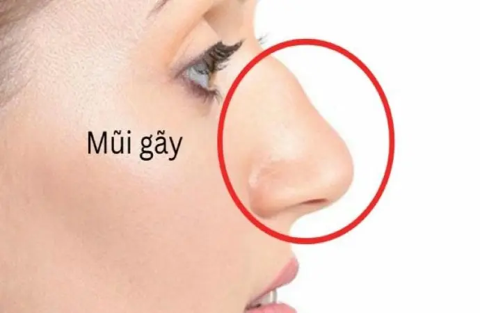 Giải mã nhân tướng học tướng mũi gãy trong cuộc sống