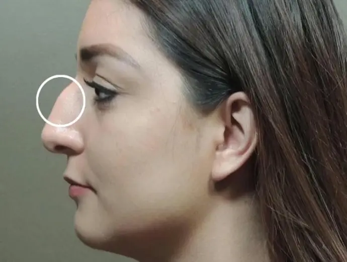 Nhận diện tướng mũi gồ và ý nghĩa trong nhân tướng học