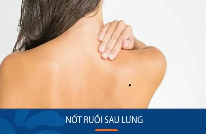 Giải mã ý nghĩa khi xem tướng qua nốt ruồi trên lưng