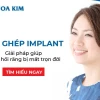Cấy ghép Implant là gì? Bí quyết sở hữu hàm răng chắc khỏe bền lâu