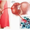 Chlamydia là gì? Nguyên nhân, triệu chứng và cách phòng ngừa hiệu quả