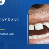 Mơ thấy gãy răng là điềm báo gì? Giải mã giấc mơ chi tiết