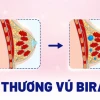 Sang thương vú BIRADS 2 là gì? Ý nghĩa và cách xử lý