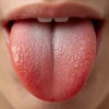 Viêm Gai Lưỡi Là Gì? Nhận Biết Dấu Hiệu và Biện Pháp Xử Lý Hiệu Quả