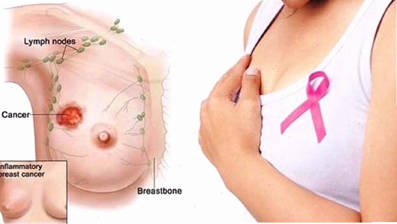 Ảnh minh họa các dấu hiệu bất thường cần lưu ý ở vú