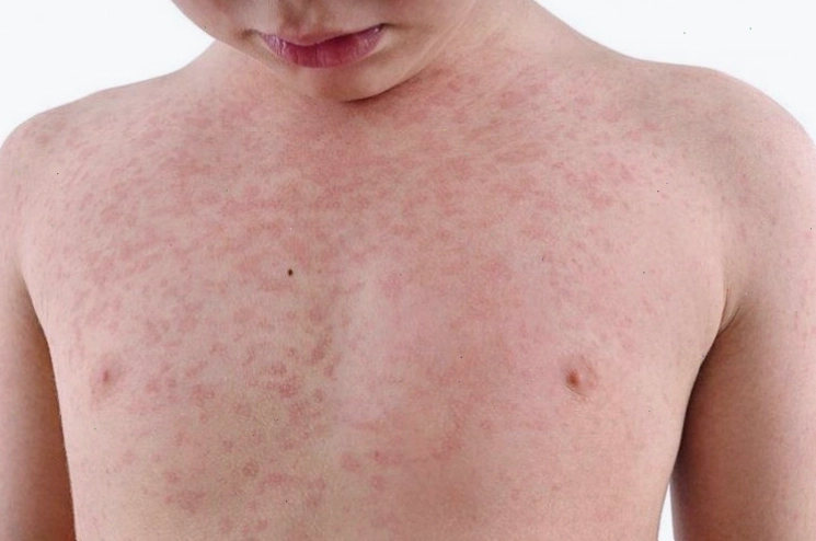 Ban mọc trên cơ thể người mắc bệnh Rubella