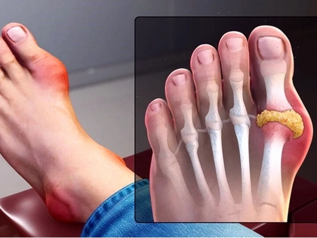 Bệnh gout (gout) là gì? Triệu chứng, chẩn đoán và cách điều trị - Ảnh minh họa