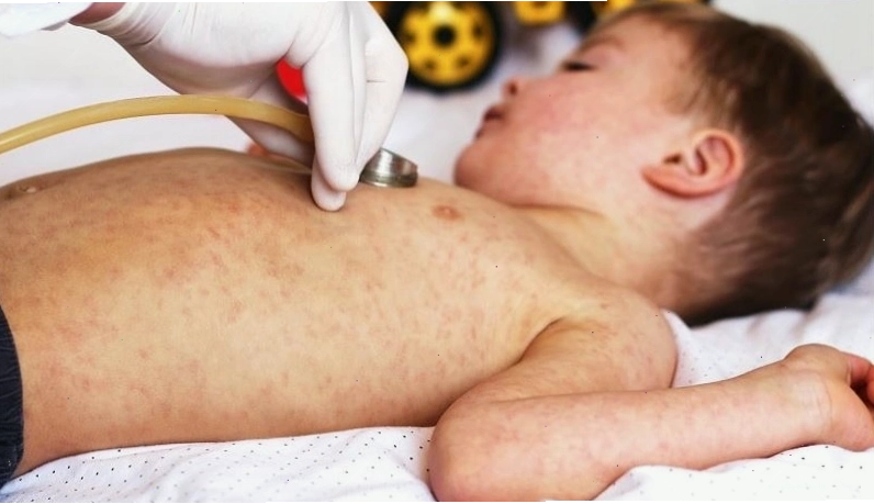 Biểu hiện ban đỏ trên da của người bệnh Rubella
