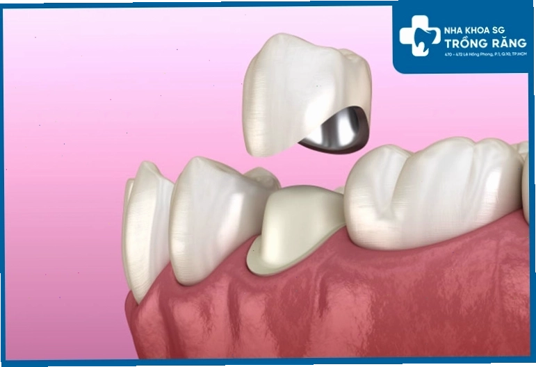 Bọc răng sứ thẩm mỹ cho nụ cười tỏa sáng