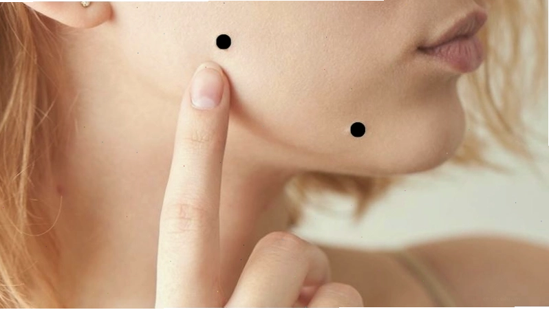 Cách tẩy nốt ruồi hiệu quả tại nhà cần tham khảo ý kiến chuyên gia