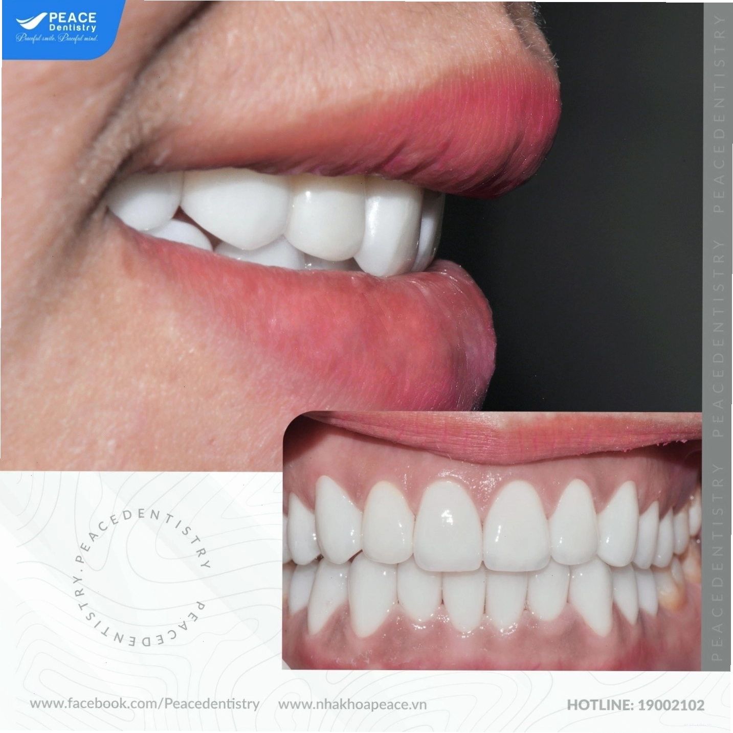 Case bọc răng sứ cho răng cửa tại Nha Khoa Peace Dentistry