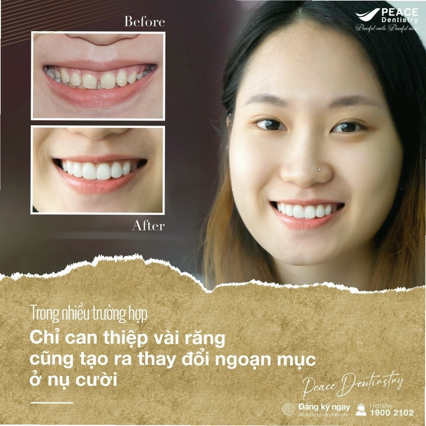 Case dán sứ veneer cho răng cửa thưa tại Nha Khoa Peace Dentistry