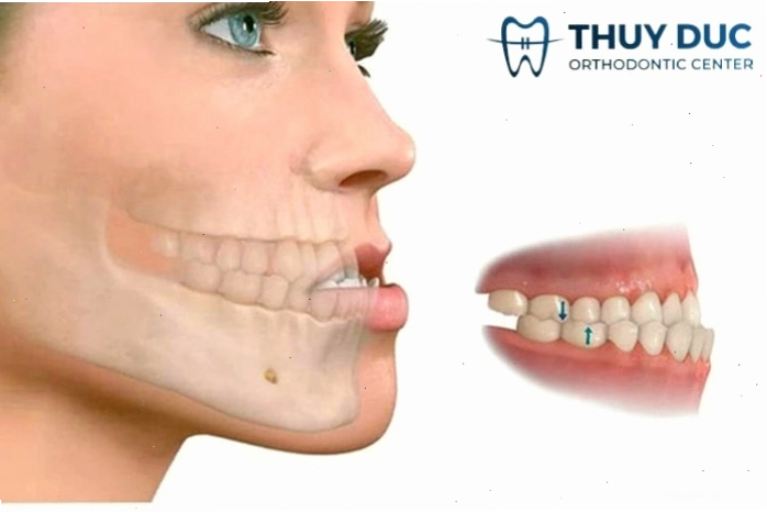 Cấu trúc hàm mặt ảnh hưởng đến việc nói chuyện có hở răng hay không
