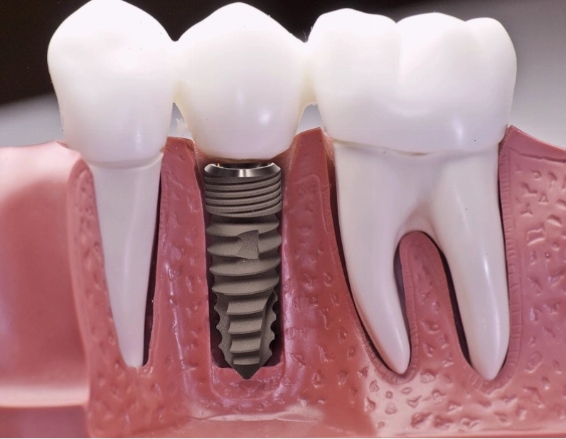 Cấy ghép Implant là kỹ thuật tạo răng giả thay thế răng đã mất