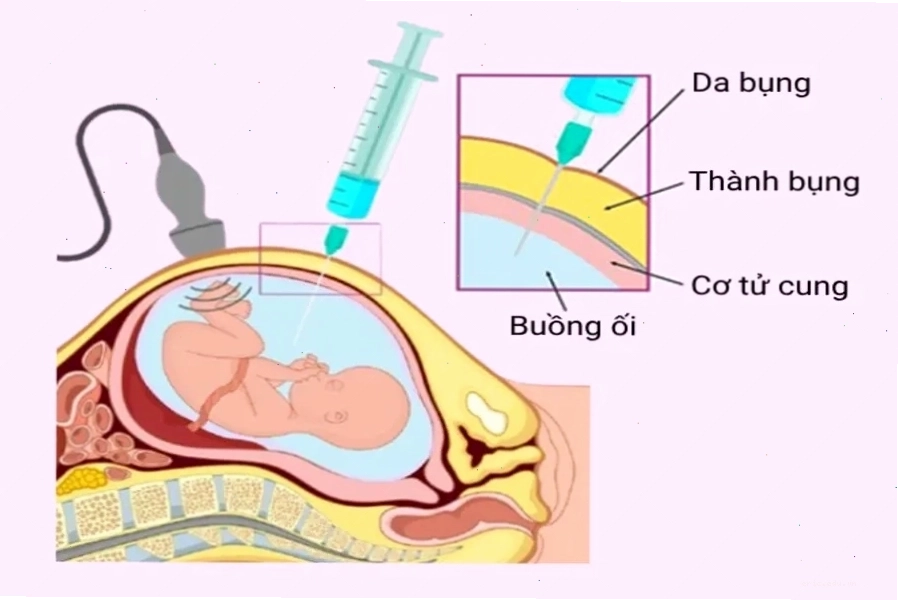 Chọc ối là thủ thuật y khoa giúp kiểm tra sức khỏe thai nhi