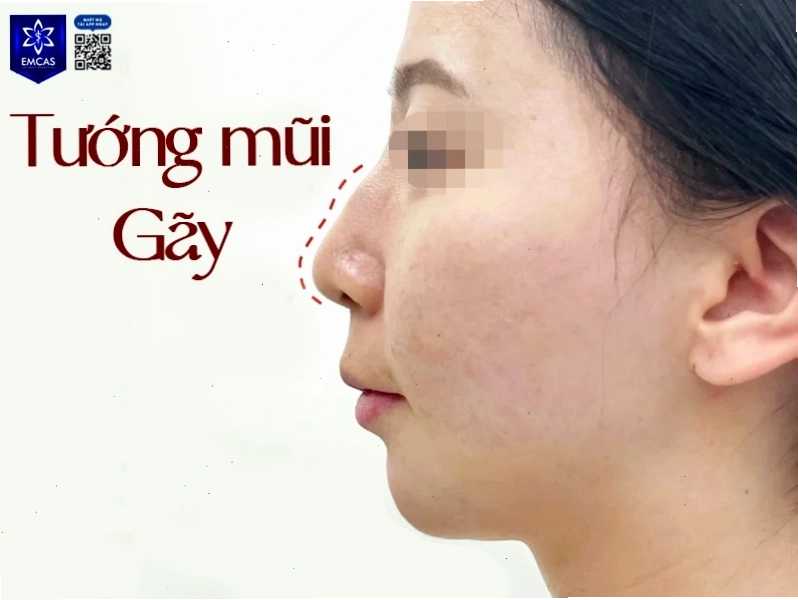 Đặc điểm nhận dạng tướng mũi gãy ở phụ nữ