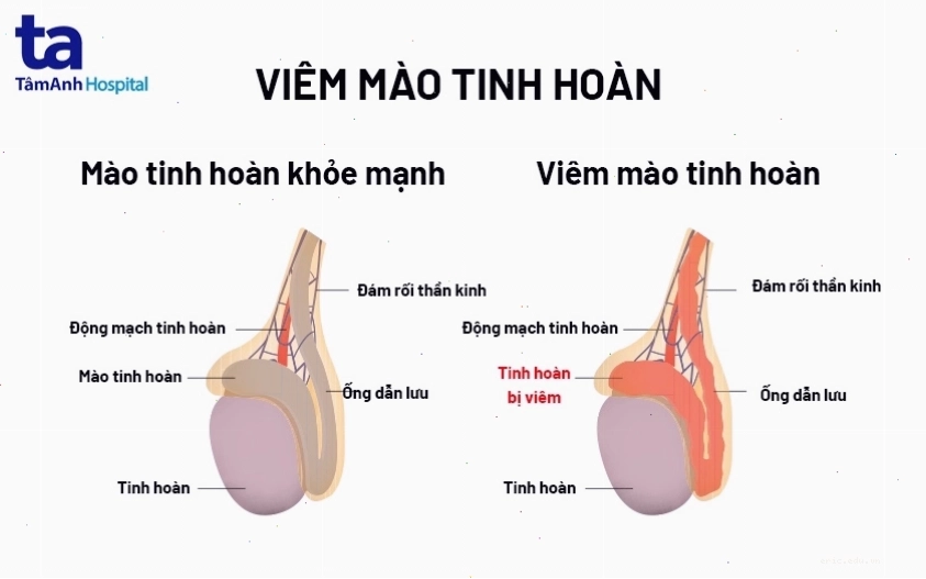 Dấu hiệu và triệu chứng của viêm mào tinh hoàn