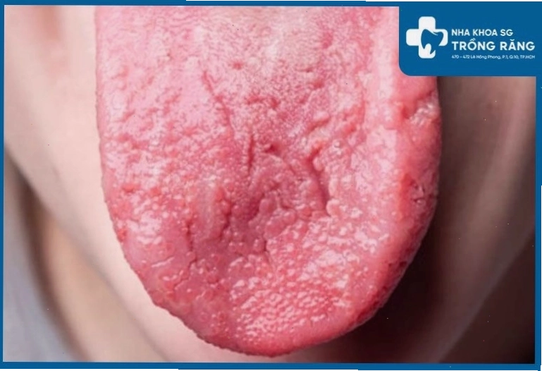 Gai lưỡi bị sưng viêm, nổi hạt và ửng đỏ