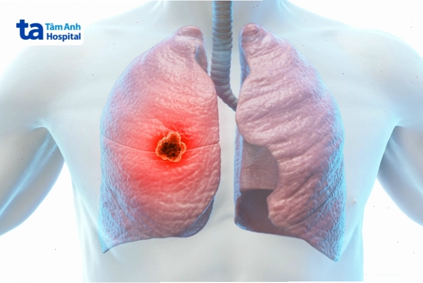 Hình ảnh khối u ác tính ở đỉnh phổi