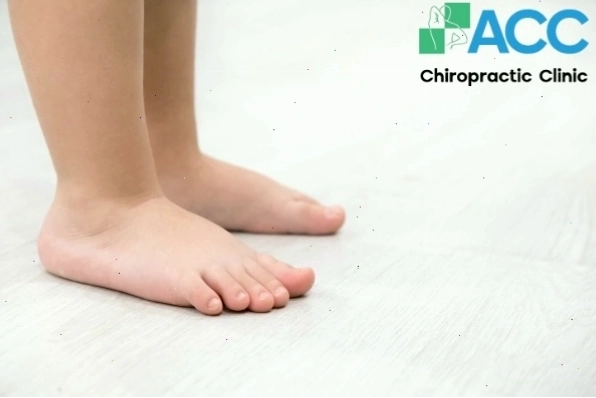 Hình ảnh minh họa bàn chân phẳng của trẻ em