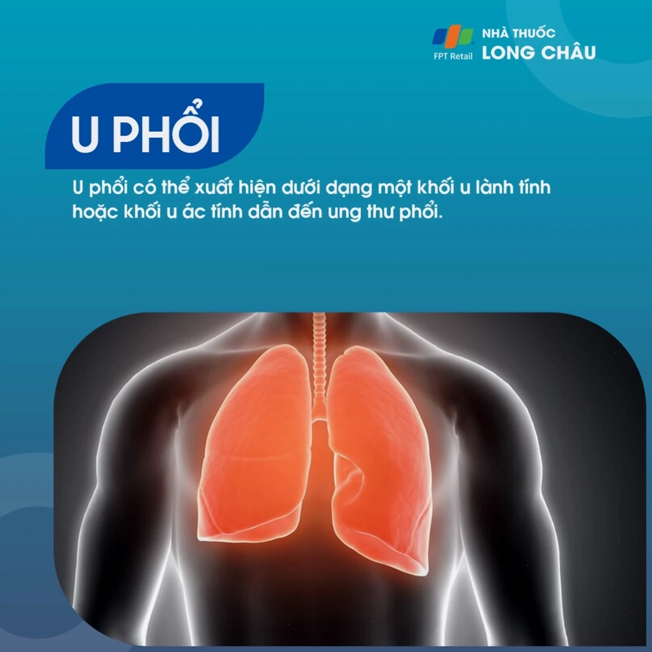 Hình ảnh minh họa khối u phổi lành tính