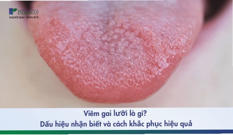 Hình ảnh minh họa tình trạng viêm gai lưỡi với các nhú gai sưng đỏ