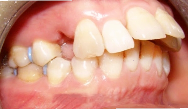 Hình ảnh minh họa tướng phụ nữ răng hô và sự ảnh hưởng đến vận mệnh