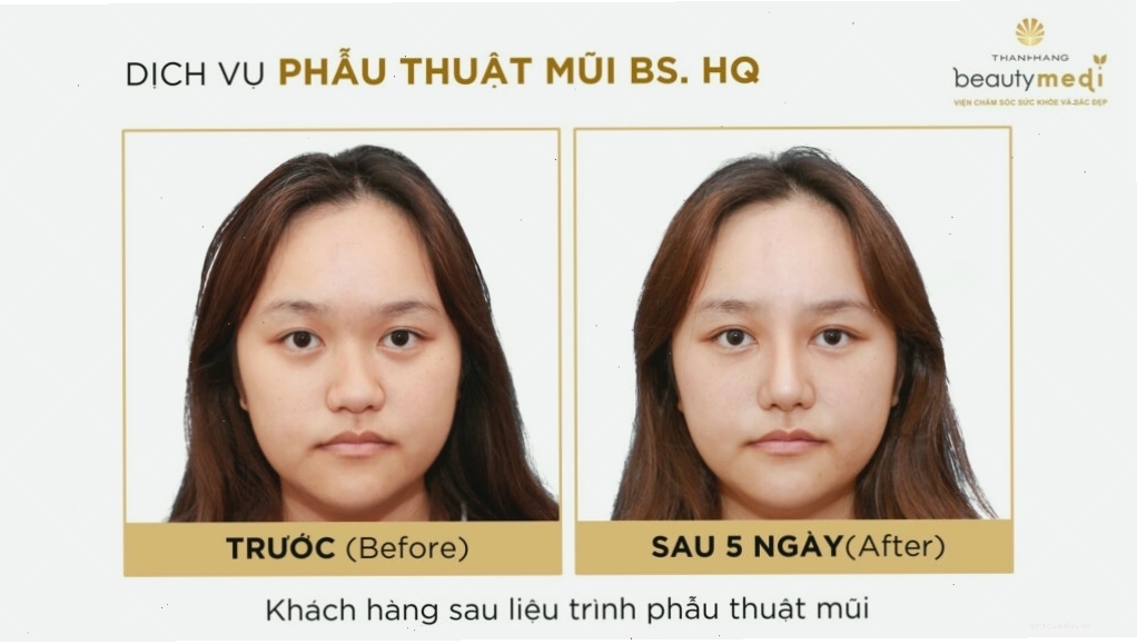 Hình ảnh trước và sau khi phẫu thuật mũi tại một trung tâm thẩm mỹ