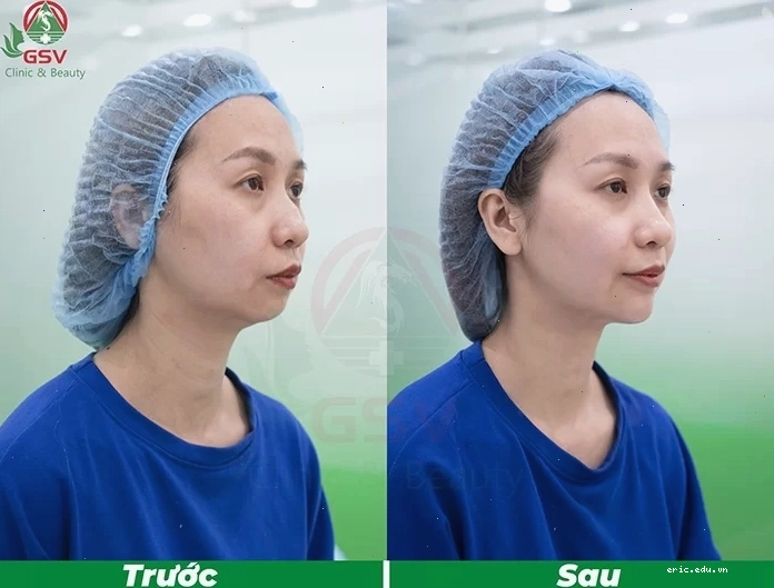 Hình dung về sự thay đổi dáng cằm