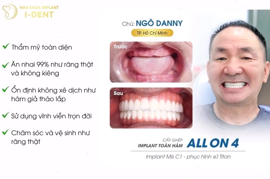 Implant là gì