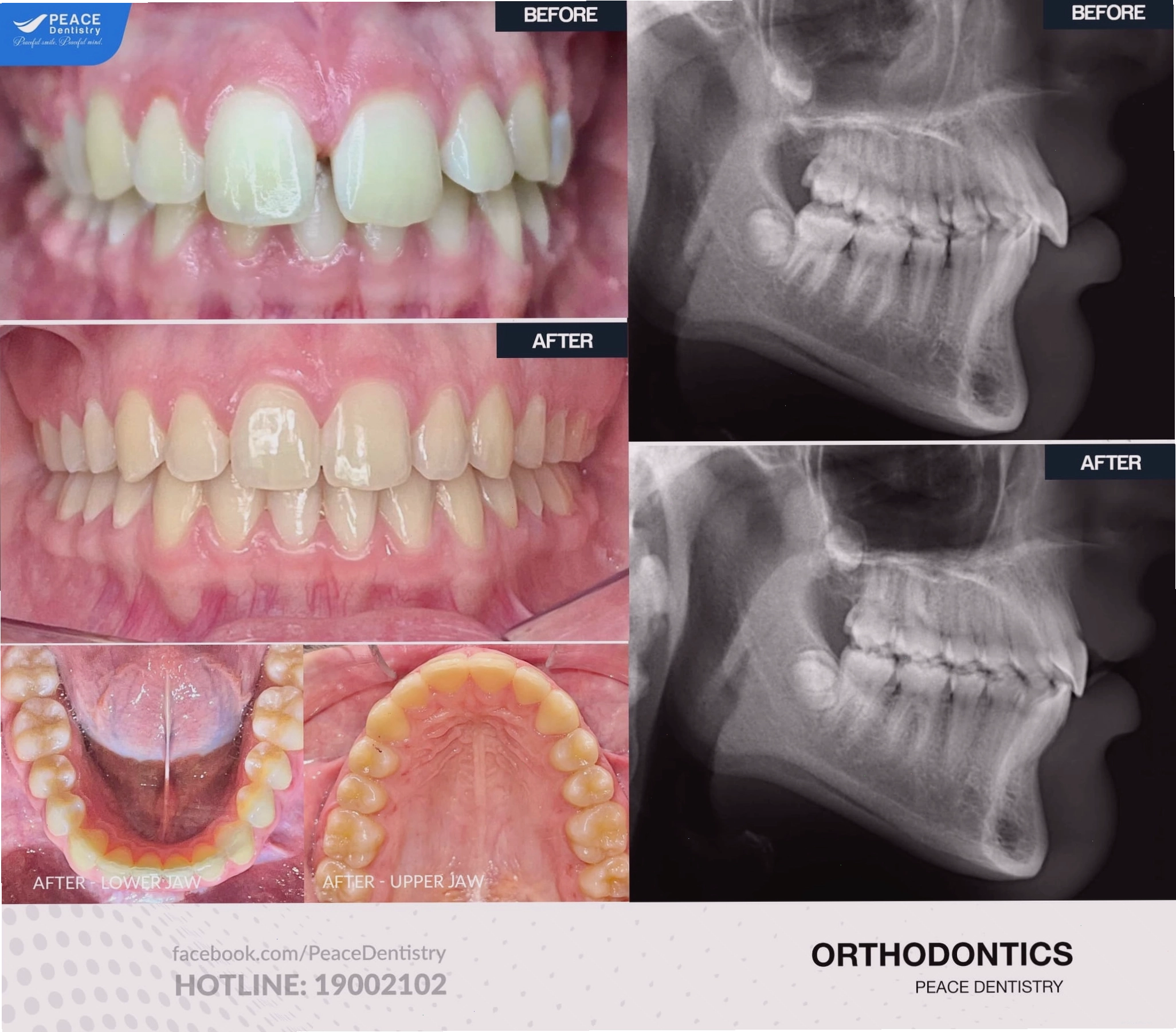 Kết quả niềng răng cửa thưa tại Nha Khoa Peace Dentistry
