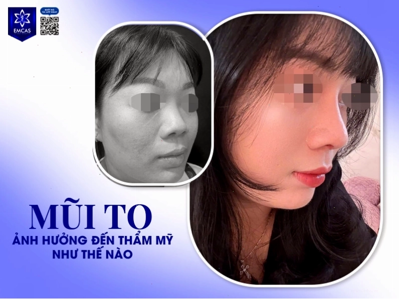 Lỗ mũi to ảnh hưởng đến thẩm mỹ khuôn mặt