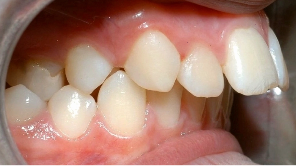 Minh họa các dạng răng hô và liên hệ với tướng số