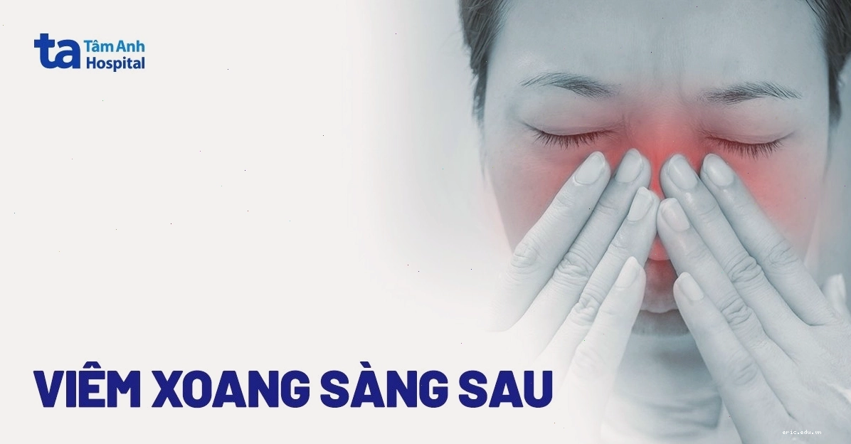 Mô tả vị trí xoang sàng sau và các cấu trúc lân cận