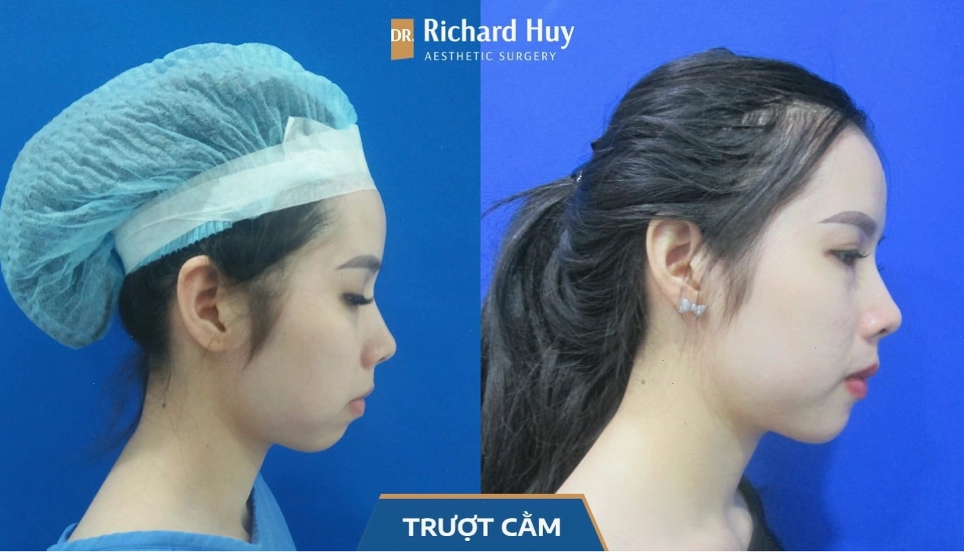 Một trường hợp chỉnh sửa khuyết điểm khuôn mặt