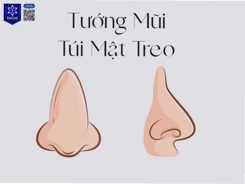 Mũi túi mật với đầu mũi to tròn đầy