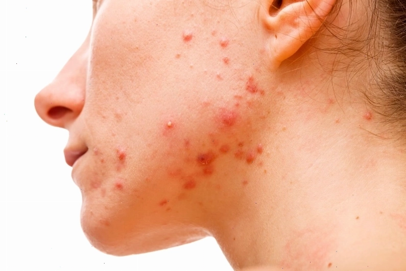 Mụn áp xe là tình trạng viêm nhiễm da do vi khuẩn gây ra.