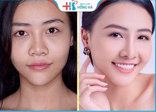 Nâng mũi đẹp giúp cải thiện tự tin và cơ hội