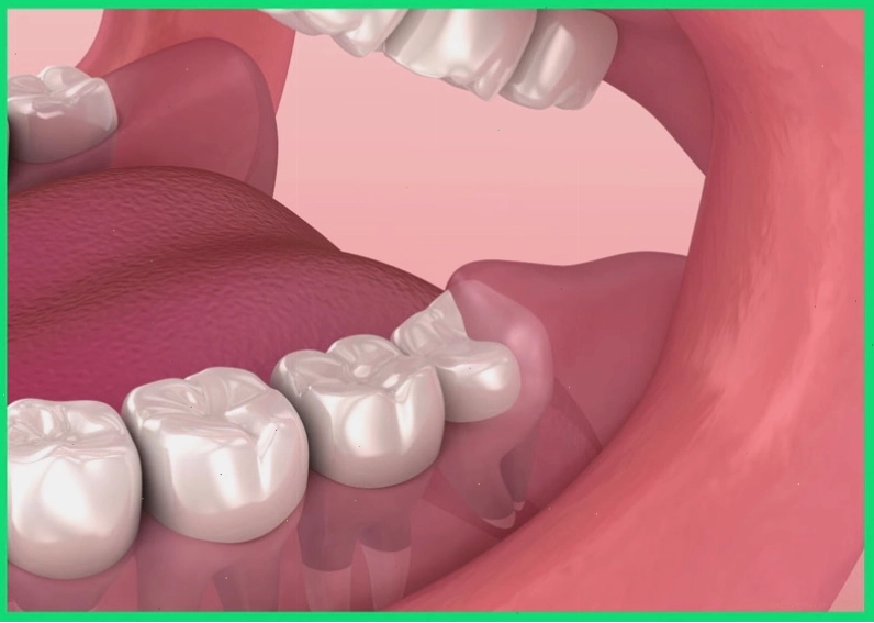 Người trưởng thành bình thường có 28 chiếc răng và 4 chiếc răng khôn