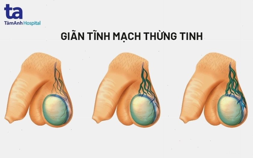 Nguyên nhân và cách điều trị giãn tĩnh mạch thừng tinh