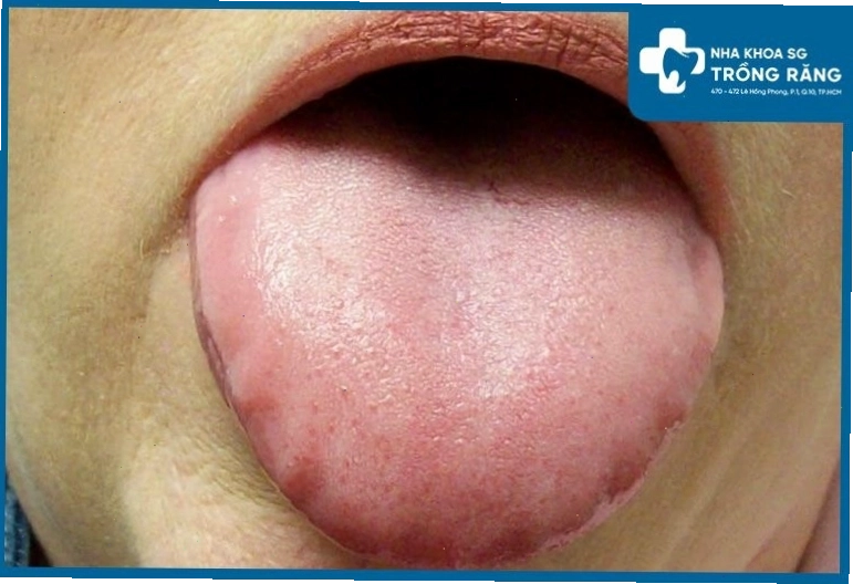 Nhú lưỡi xuất hiện một số hạt đỏ nhỏ gây khó chịu