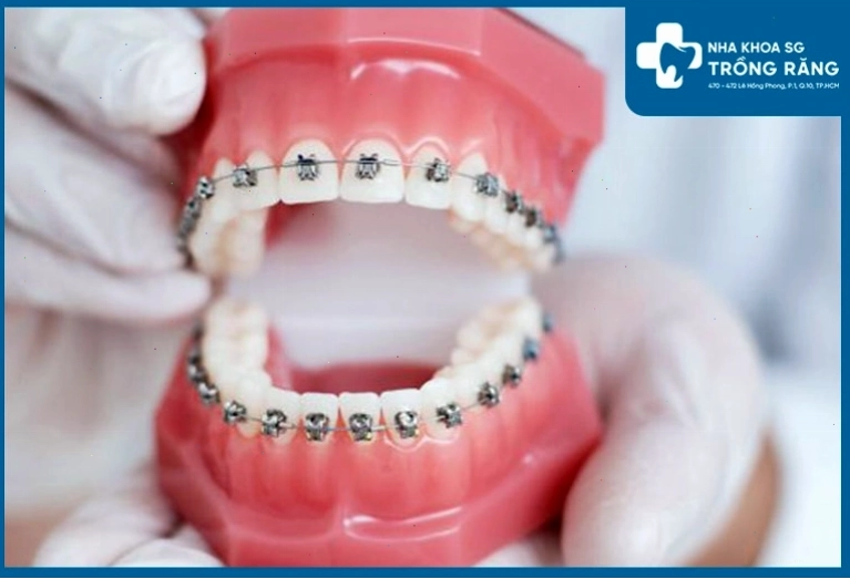 Niềng răng cải thiện tình trạng nói không hở răng