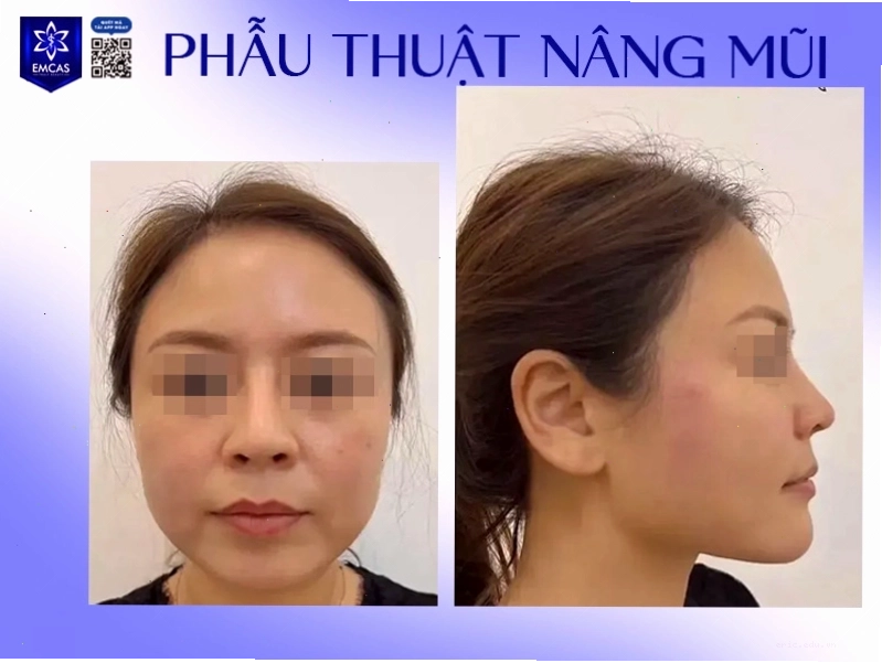 Phẫu thuật nâng mũi cải thiện dáng mũi to
