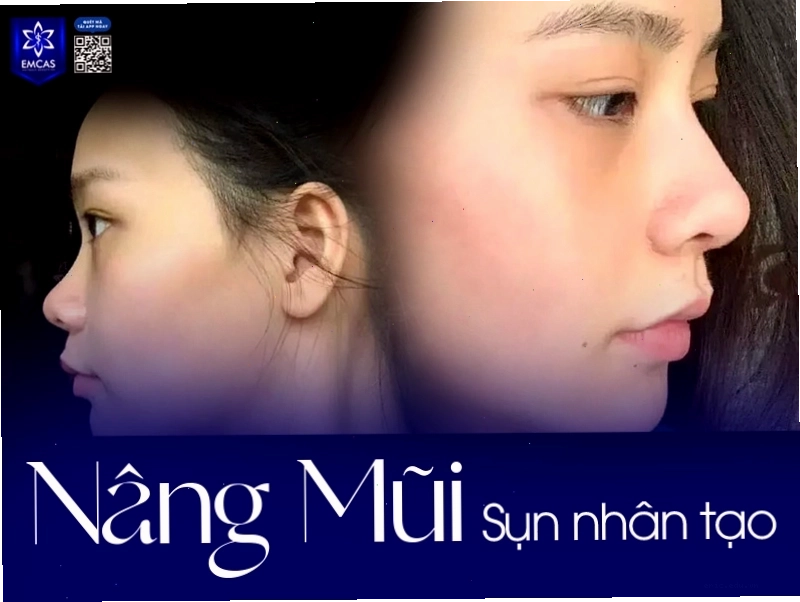 Phẫu thuật nâng mũi khắc phục tướng mũi gãy hiệu quả