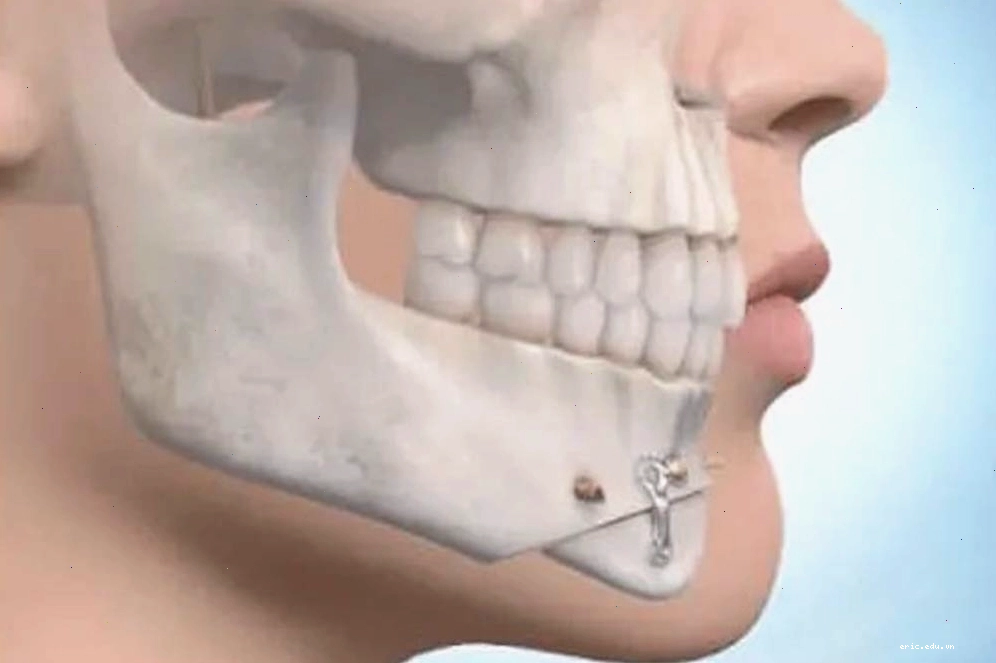 Phẫu Thuật Trượt Cằm